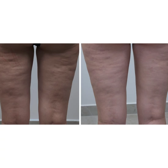 Anticellulit fogyi csomag 